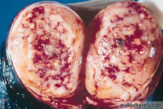 Testicular tumours pptx - D. Hameed - Muhadharaty