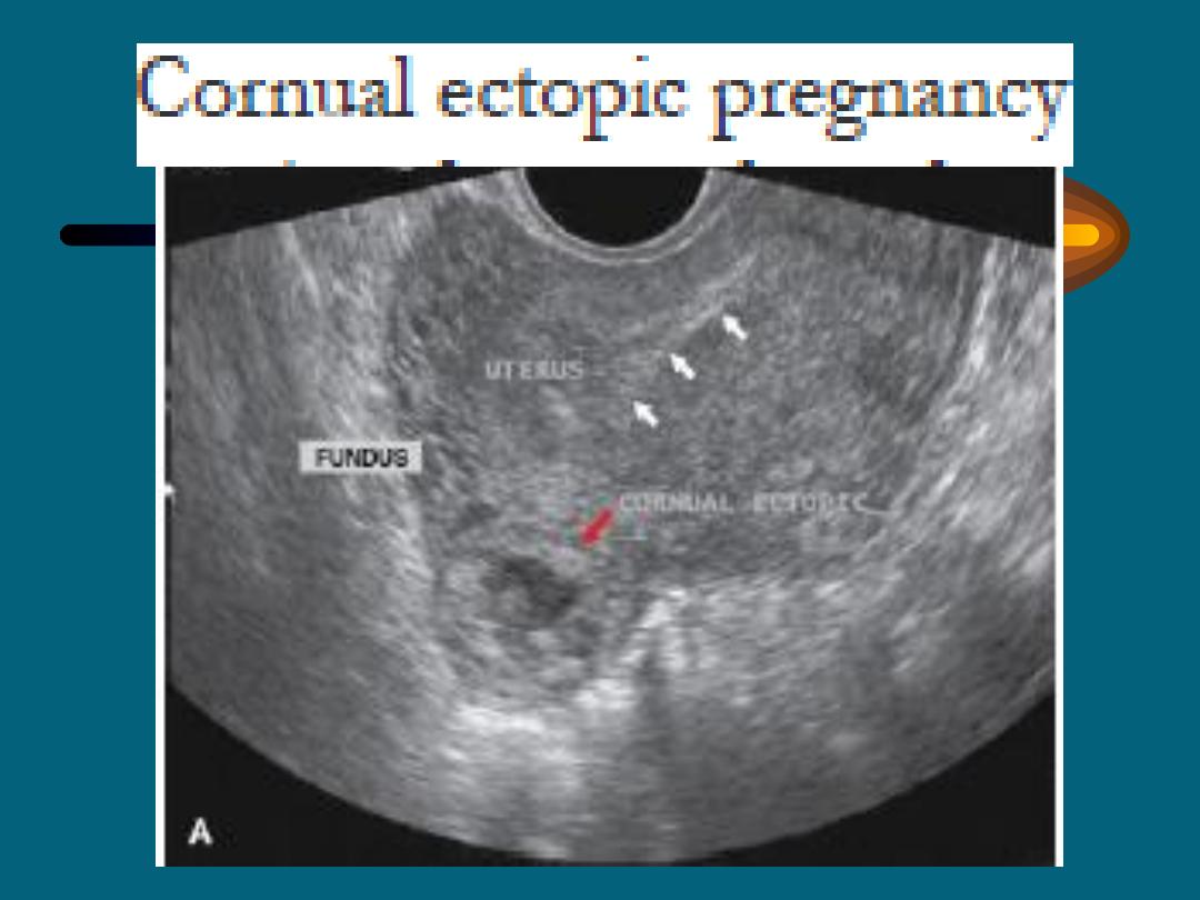 Ectopic pregnancy dr.Etemad pdf - All Lectures - Muhadharaty