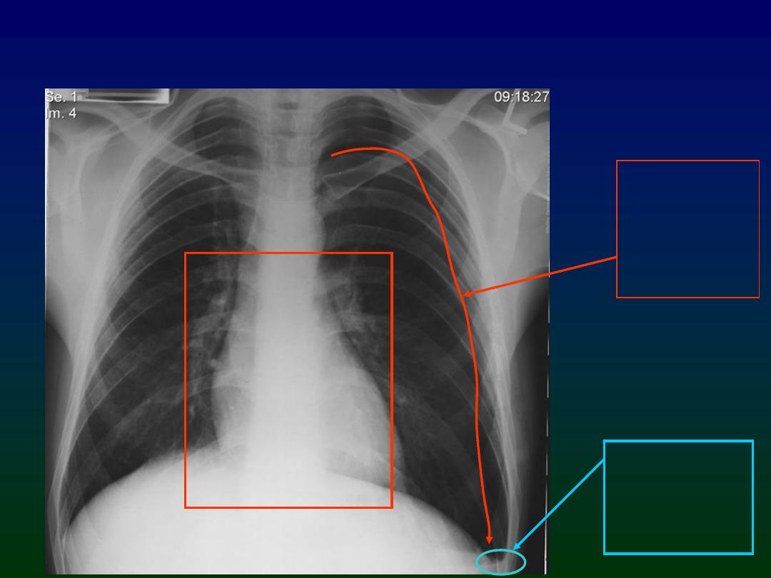 Chest trauma & pneumothorax pdf - Dr.Sameir - Muhadharaty