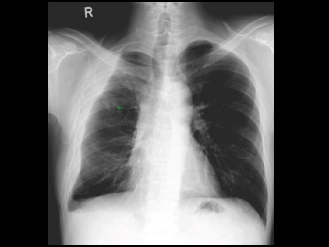 Pleural effusion pdf - Dr.Sameir - Muhadharaty