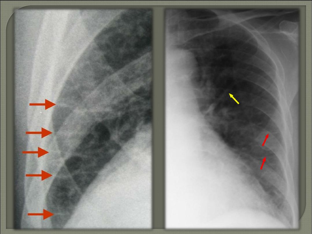 Pulmonary edema pdf - Dr.Sameir - Muhadharaty