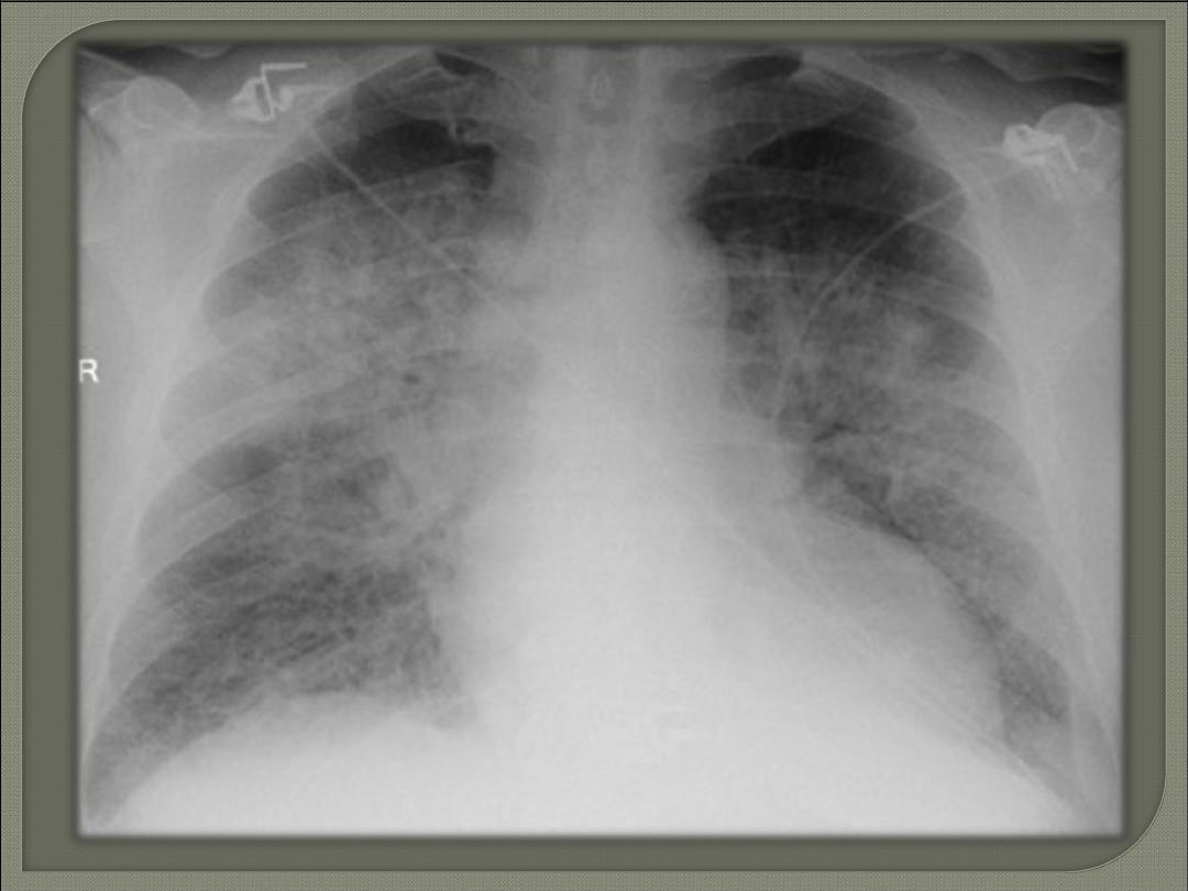 Pulmonary edema pdf - Dr.Sameir - Muhadharaty